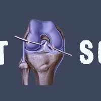 Ligamentsolution